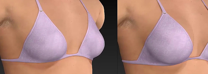 3D imaging of breasts.