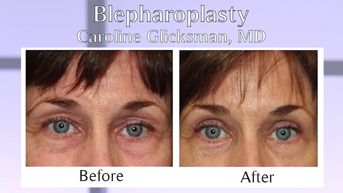 Eyelid surgery before and afters Dr. Glicksman.