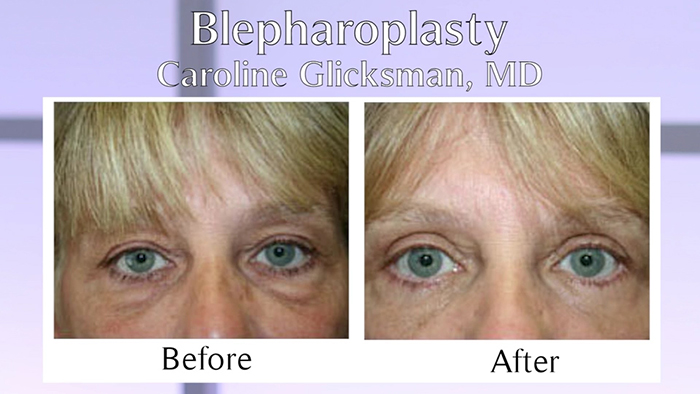 Blepharoplasty before and after Dr. Glicksman.