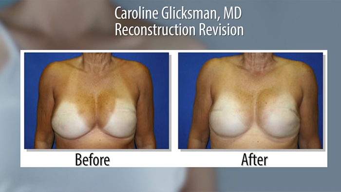 breast reconstruction revision before and after