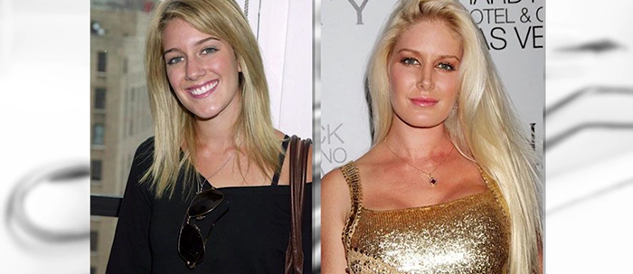 Heidi Montag regretful plastic surgery.