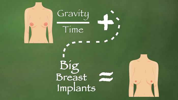 Big implants over time.