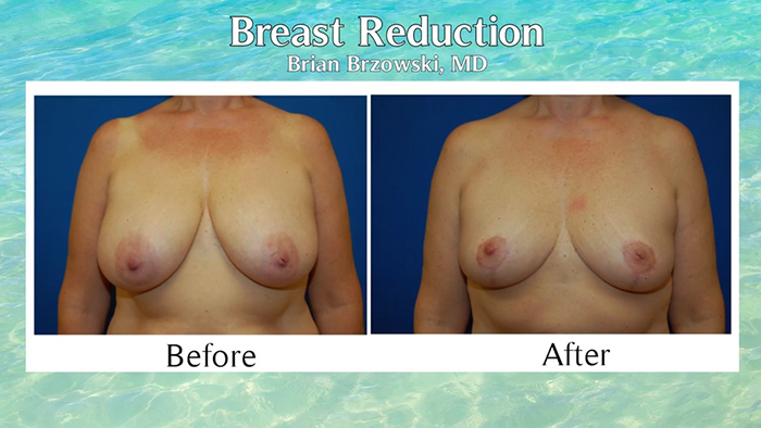 Right-sized breasts before and after.