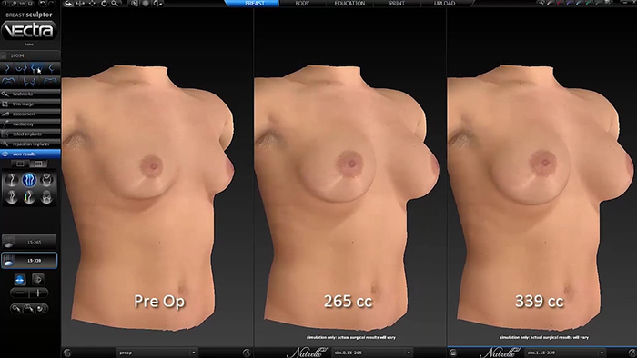 Vectrad 3D implant sizing.