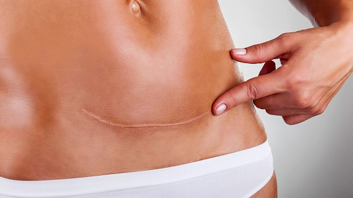 Tummy tuck scars.