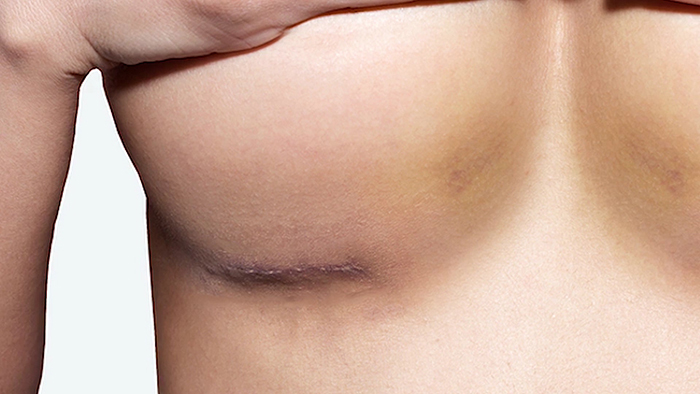 Breast augmentation scars.