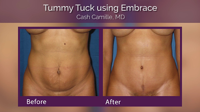 Tummy tuck scars before and afters.