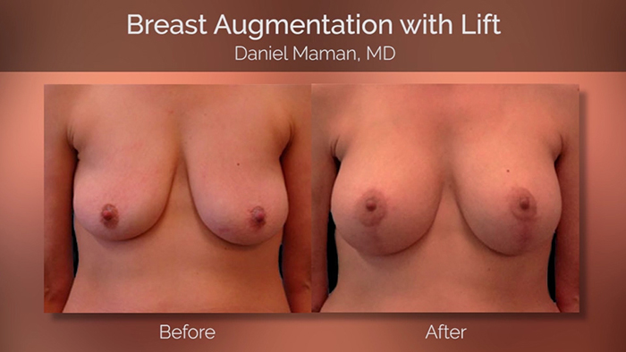 Breast augmentation scars before and afters.