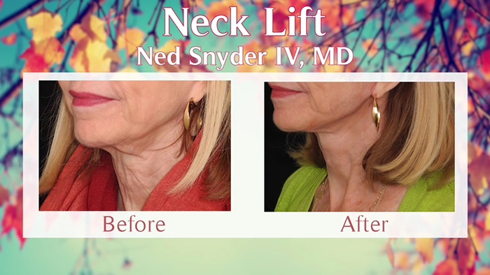 Neck contouring before and after - Ned Snyder, MD.