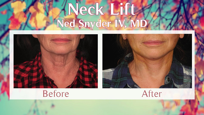 Neck lift before and after - Ned Snyder, MD.