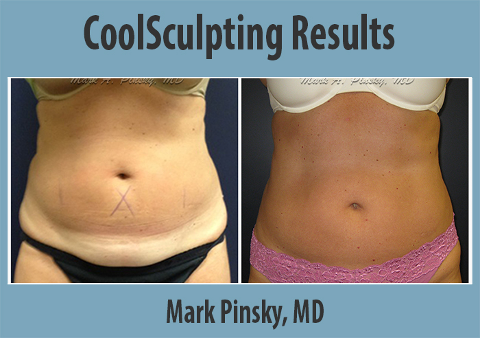 Effective technologies - CoolSculpting before and afters.