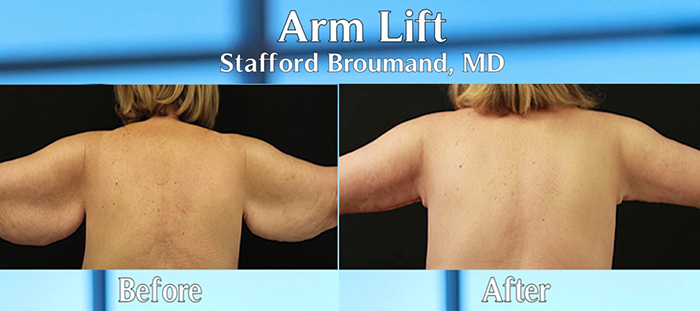 Dr. Stafford Broumand arm lift before and after.