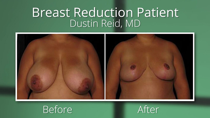 Obese patients - breast reduction before and after.