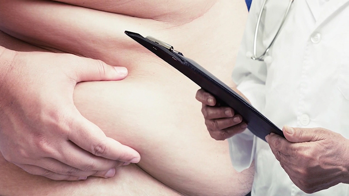 Obese patients and cosmetic surgery.