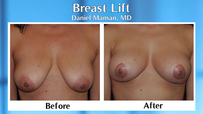 Breast lift before and afters.