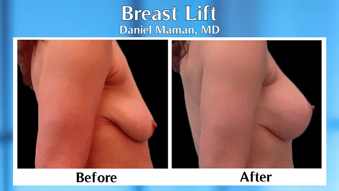 Dr. Daniel Maman breast lift before and after.