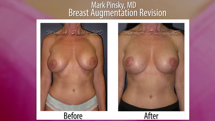 Dr. Mark Pinsky breast revision before and after.