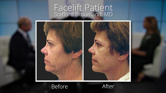 Dr. Stafford Broumand facelift before and after.