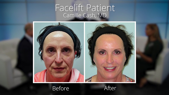 Facelift before and after Dr. Cash.