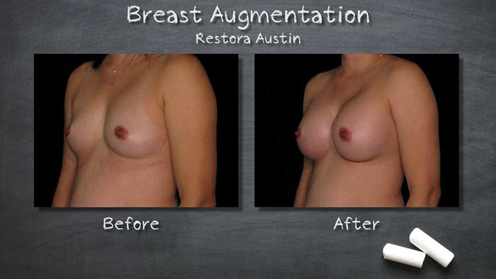 Restora Austin breast augmentation before and after.