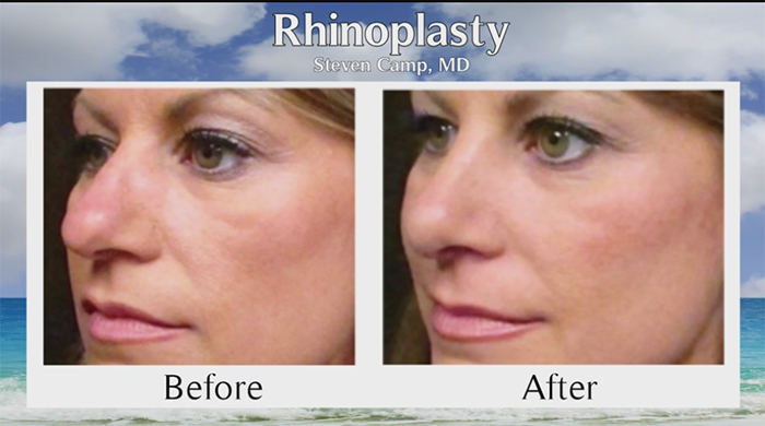 Rhinoplasty for teenagers before and after.