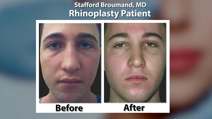 Dr. Stafford Broumand - Nose Job Before and After