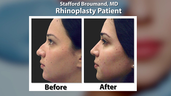 Dr. Stafford Broumand rhinoplasty before and after.