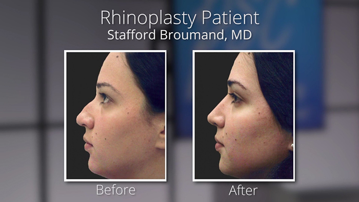 Rhinoplasty before and afters - Dr. Broumand.