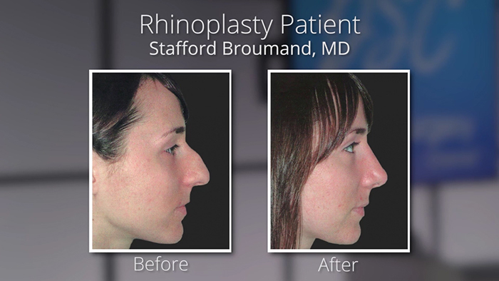 Staffound Broumand - Nose job before and afters.