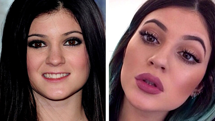 Celebrities and lip filler.