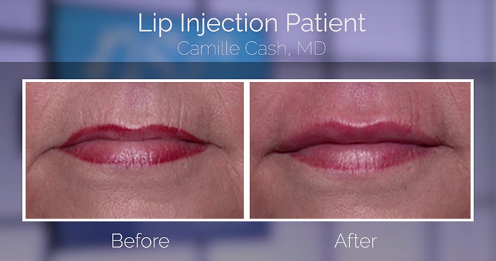 Dr. Camille Cash lip filler before and after.