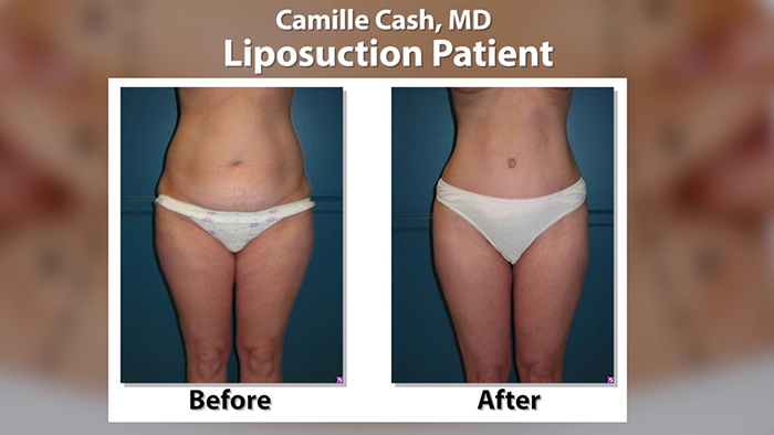 Dr. Cash lipo before and afters.