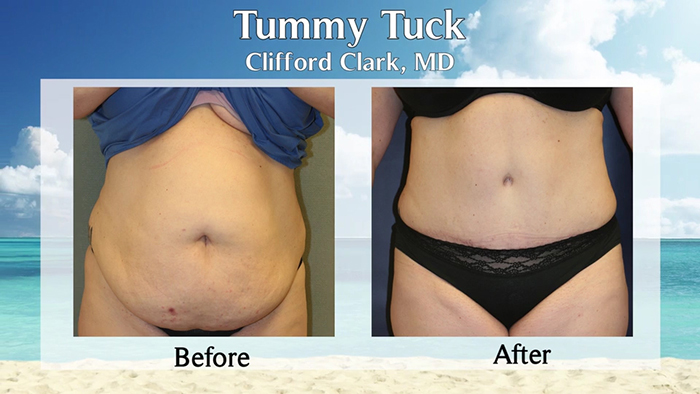 Dr. Cliff Clark mommy makeover before and after.