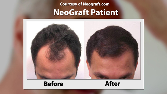 NeoGraft hair transplantation before and after.
