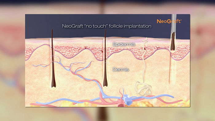 Hair transplantation technology with NeoGraft.