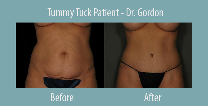 Ashley Gordon tummy tuck before and after.