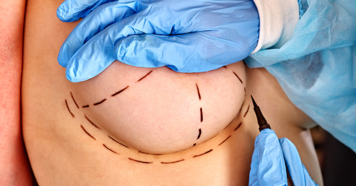 Fat grafting with breast augmentation.