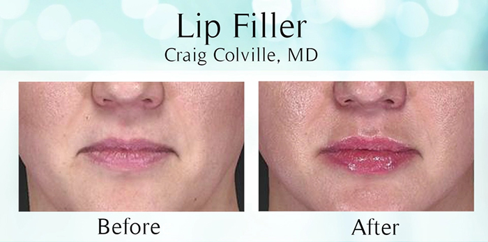 Injectables - Lip filler before and after.