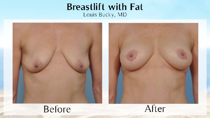 Fat grafting to the breast before and after.