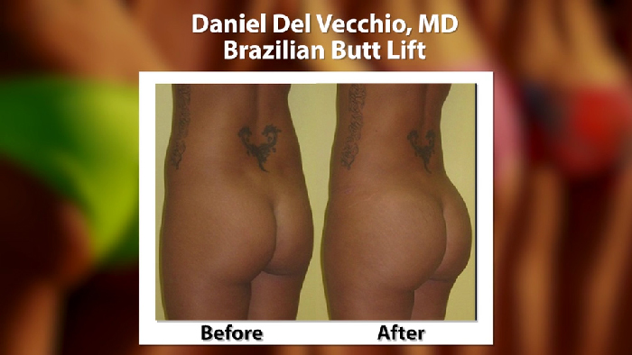 Brazilian butt lift before and after.