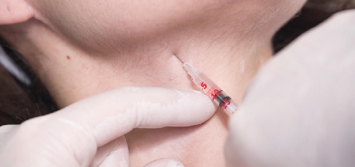 Kybella neck fat removal.