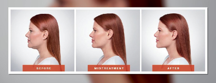 Kybella before and after.