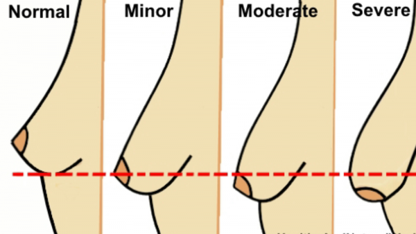 Breast lift - ptosis.