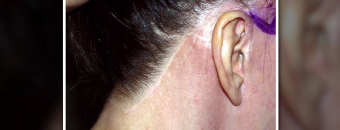 Traditional facelift - scar behind ear.