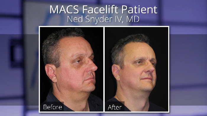 MACS facelift before and after.