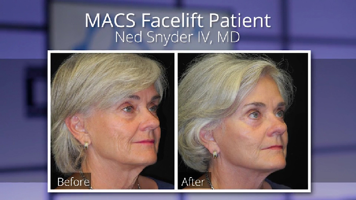 MACS facelift - Dr. Snyder before and afters.