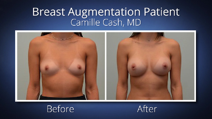 Breast augmentation and pregnancy.