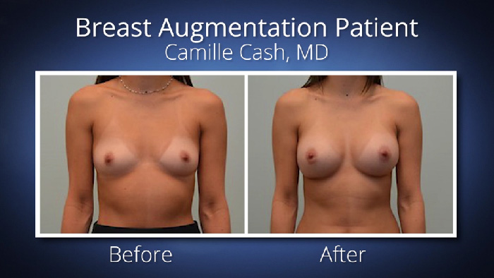 Breast augmentation and pregnancy.