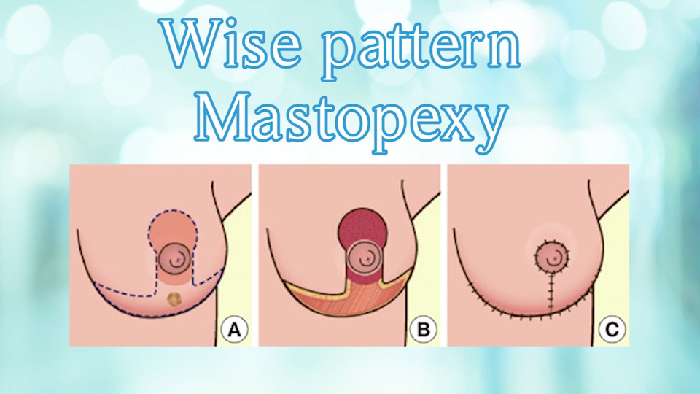 Breast lift - Wise Pattern scar.