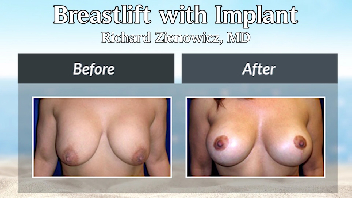 Breast lift with implants.